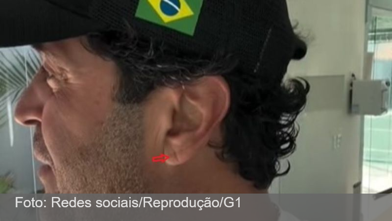Dobra na orelha: após morte de influenciador mineiro, médicos explicam qual a relação do ‘sinal de Frank’ com risco de infarto