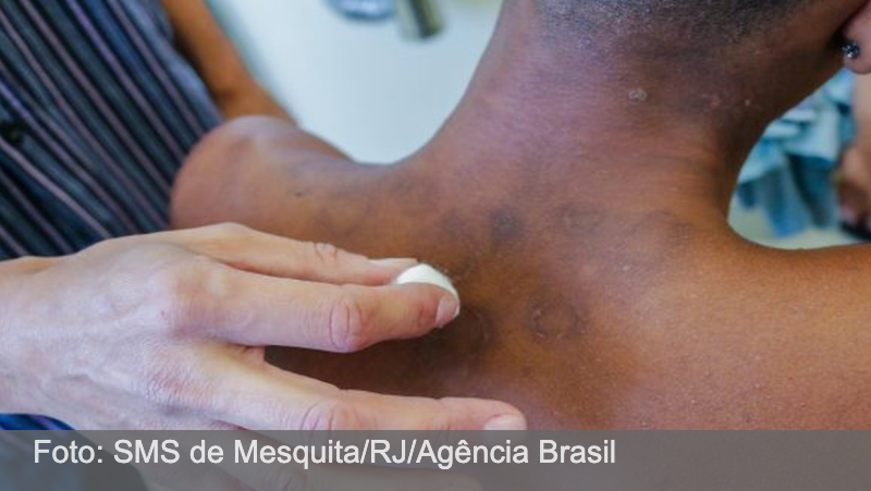 Juiz de Fora é referência no tratamento de hanseníase; Brasil é o 2º país com mais diagnósticos