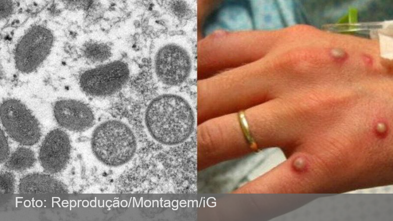 Varíola dos macacos: Rio de Janeiro confirma primeiro caso da doença