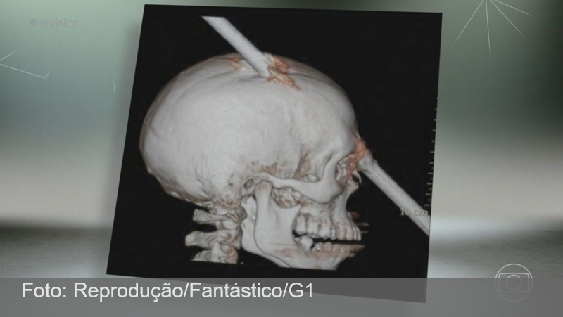 Brasileiro que sobreviveu após ter a cabeça atravessada por um vergalhão há dez anos ajuda cientistas em estudos sobre lesões no cérebro