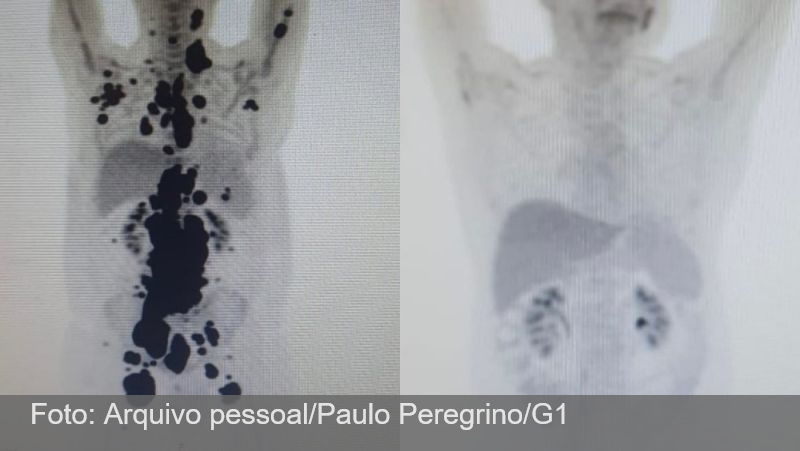 CAR-T Cell: 9 em cada 10 pacientes com linfoma não Hodgkin tiveram redução significativa após terapia desenvolvida pela USP, aponta estudo