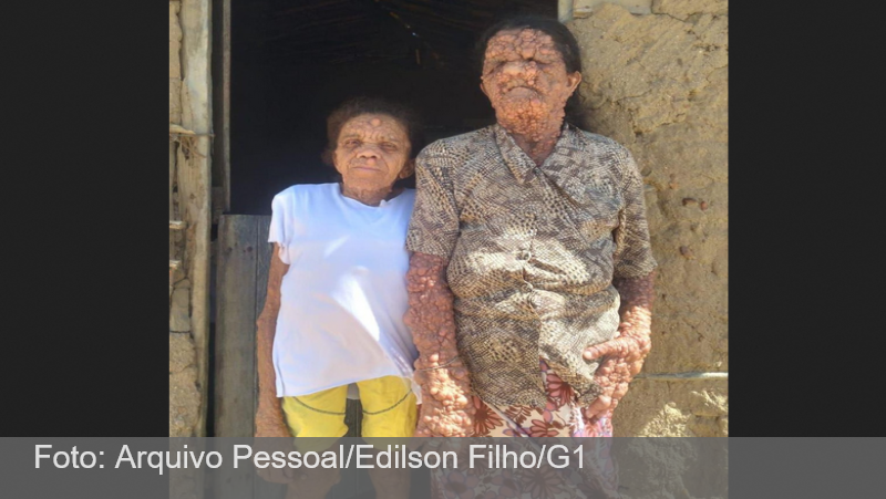 Neurofibromatose: mãe e filha na Paraíba convivem com doença rara que atravessa gerações: ‘O povo se afasta da gente, mas entrego na mão de Deus’