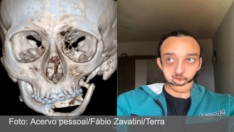 Caso raro no Brasil: jovem se prepara para reconstrução facial com prótese feita em impressora 3D
