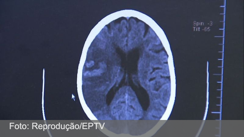 AVC mata 1 brasileiro a cada 6 minutos, e 80% dos casos poderiam ser evitados