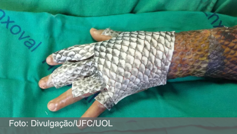 Universidade cede patente, e curativo de pele de tilápia chegará a hospitais