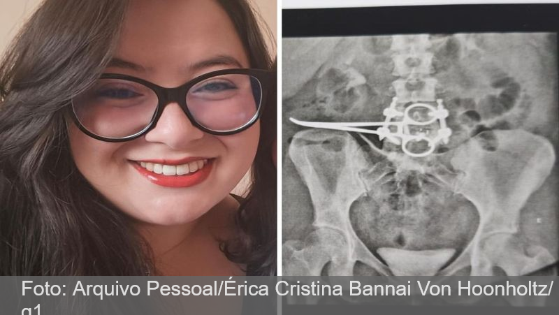 Pinça cirúrgica é esquecida dentro de abdômen de mulher em SP