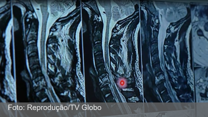 Pesquisa brasileira: Como proteína pode fazer pessoas voltarem a andar após lesão na medula