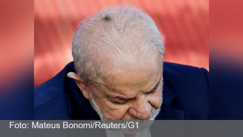 Lula tira lesão de pele no couro cabeludo e tem alta para casa