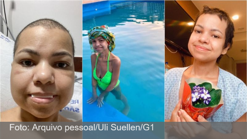 Após bariátrica, jovem tem quadro raro, passa meses na UTI e reverte cirurgia que causou desnutrição